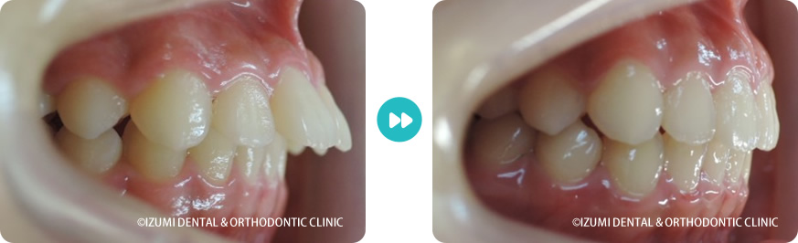 右側:インビザライン症例