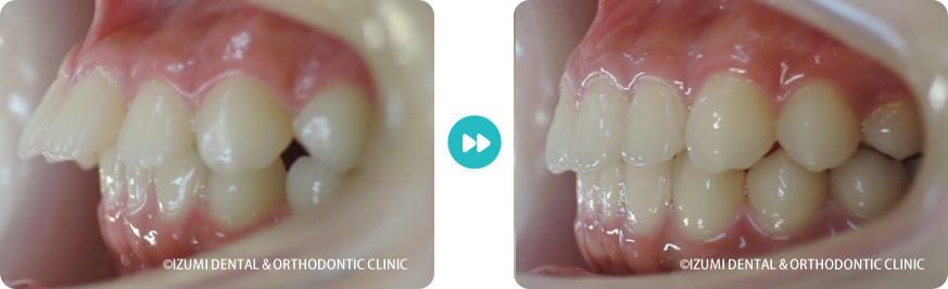 左側:インビザライン症例
