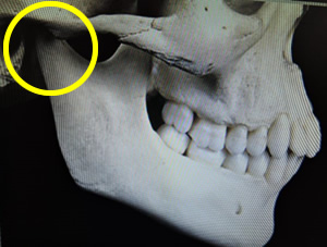 大人の顎関節