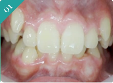 マルチループからマウスピース型(インビザライン)へ移行