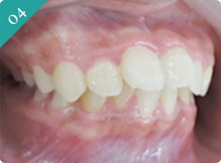 出っ歯(上顎前突、下顎の後遺症)