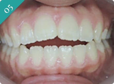 前歯が開いている(開咬)