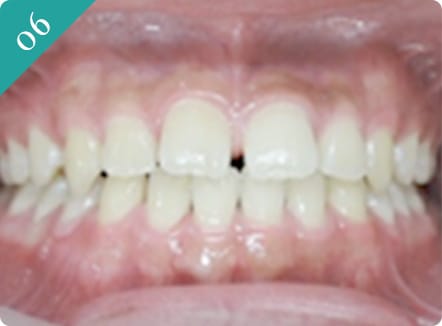 隙間が気になる(空隙歯列)
