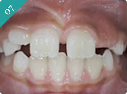 10歳未満の矯正(インビザライン・ファースト)