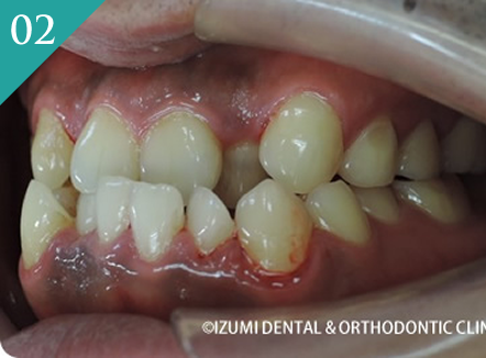 外科(骨切り)処置を回避できた症例01