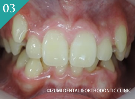 マルチループからマウスピース型（インビザライン）へ移行