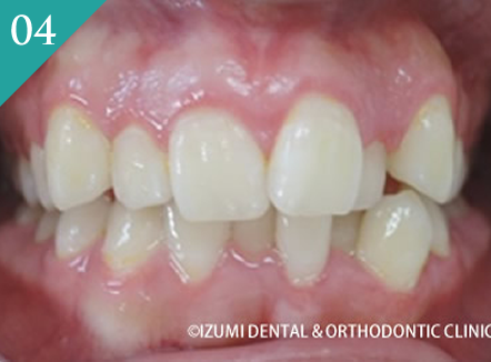 歯並びが悪いインビザライン症例
