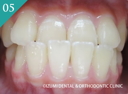 受け口と歯並びの改善