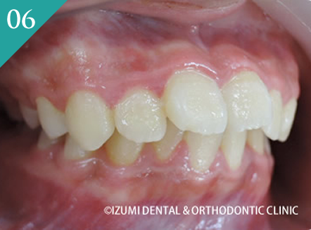出っ歯（上顎前突、下顎の後退症）