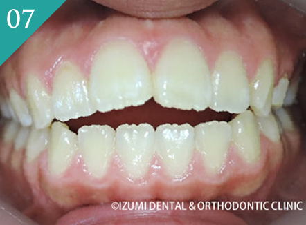 前歯が開いている（開咬）