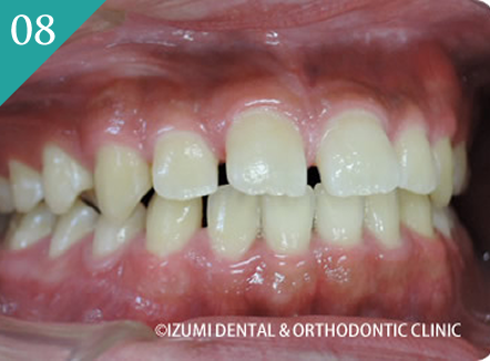隙間が気になる（空隙歯列）
