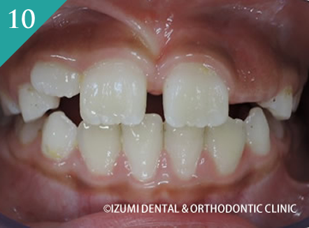 10歳未満の矯正（インビザライン・ファースト）