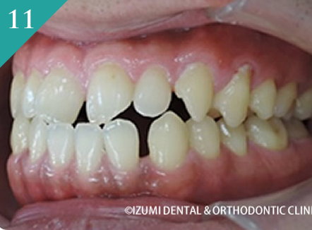 下顎が出ている（反対咬合、受け口）