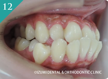 受け口・顎偏位